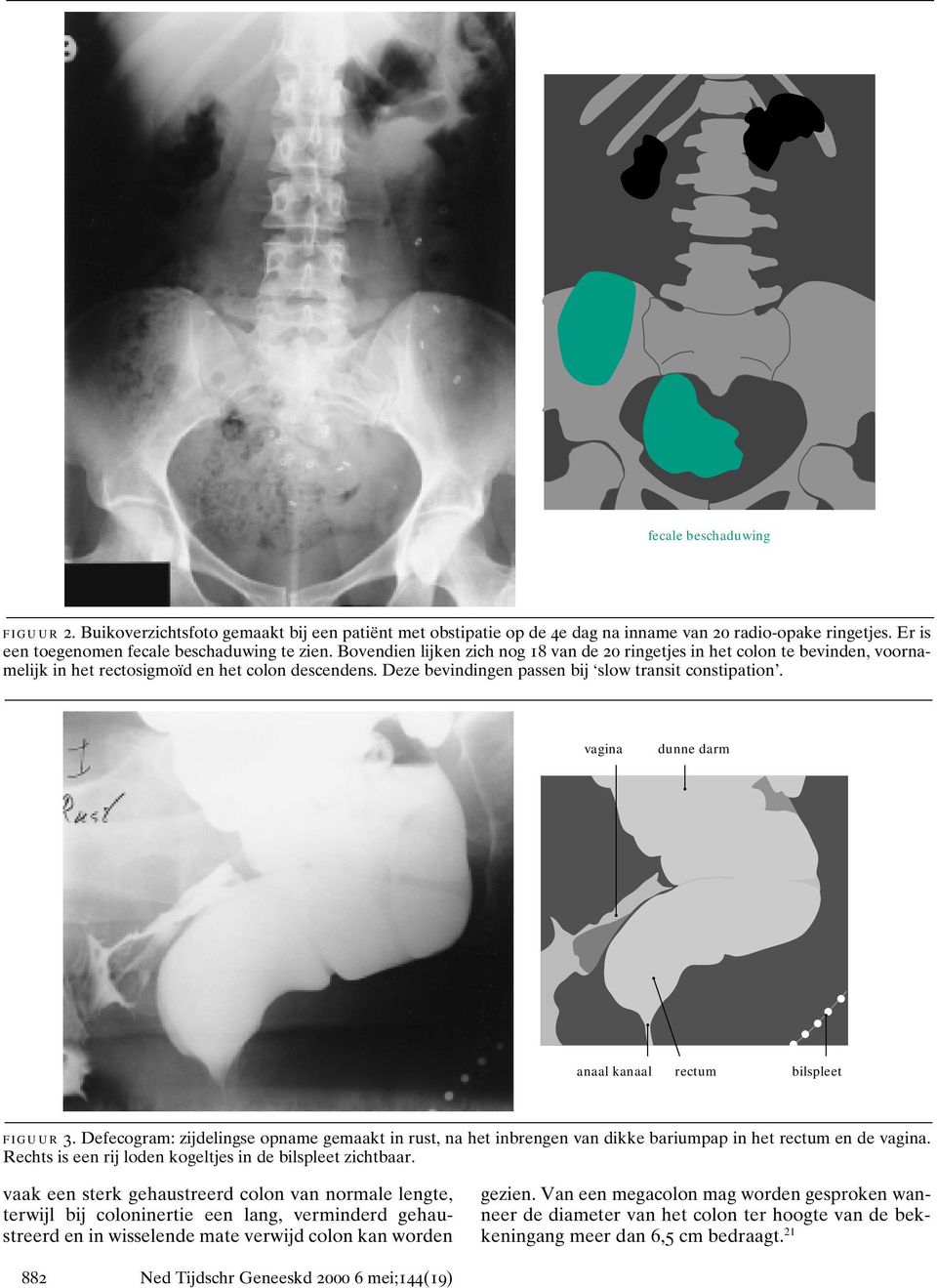 vagina dunne darm anaal kanaal rectum bilspleet figuur 3. Defecogram: zijdelingse opname gemaakt in rust, na het inbrengen van dikke bariumpap in het rectum en de vagina.
