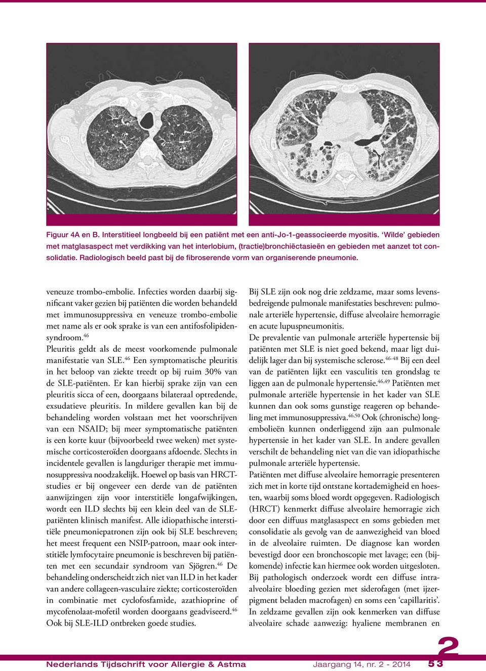 Radiologisch beeld past bij de fibroserende vorm van organiserende pneumonie. veneuze trombo-embolie.