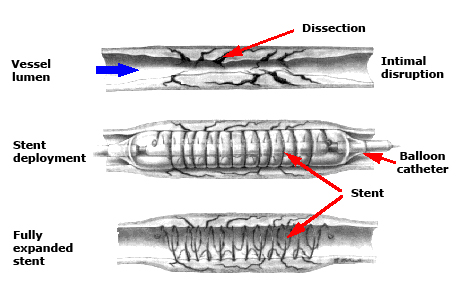 Een stent is een klein, roostervormig metalen buisje dat zich op het uiteinde van de ballonkatheter bevindt.