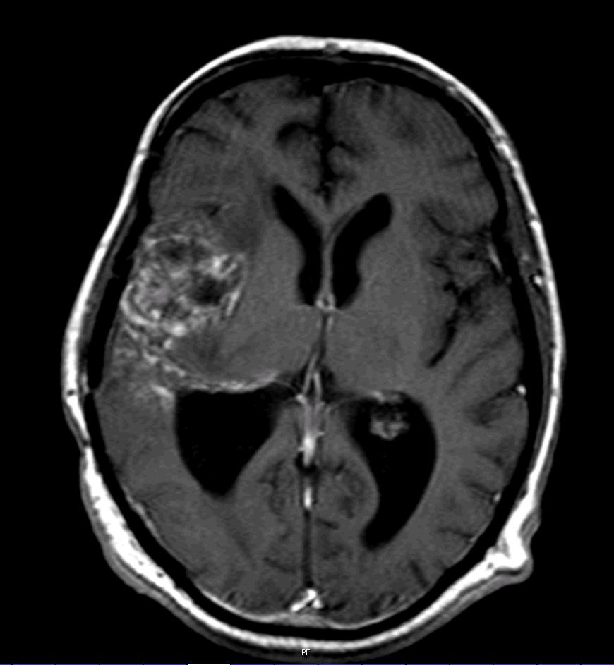 2012 MRI 4: progressie