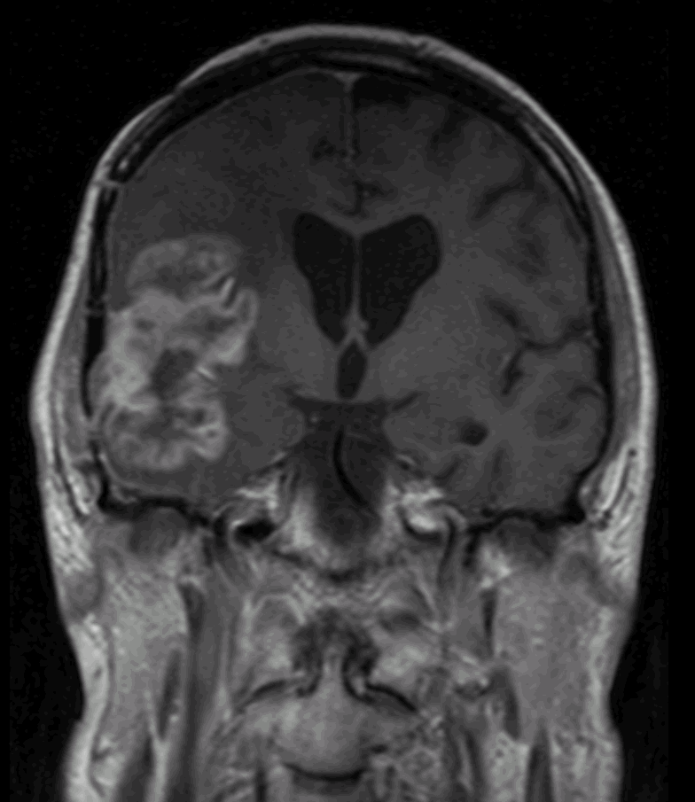 MRI 3: beeld suggestief