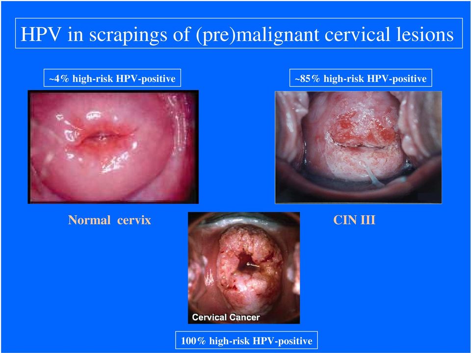 HPV-positive ~85% high-risk