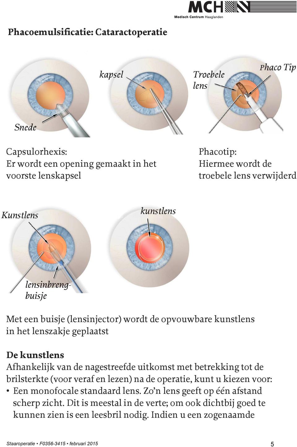 Afhankelijk van de nagestreefde uitkomst met betrekking tot de brilsterkte (voor veraf en lezen) na de operatie, kunt u kiezen voor: Een monofocale standaard lens.