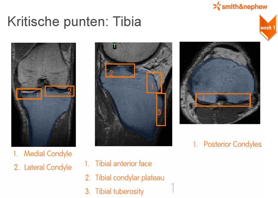 Tibia