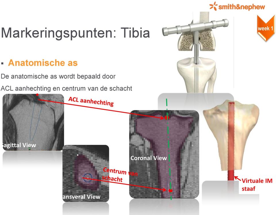 aanhechting en centrum van de schacht Sagittal