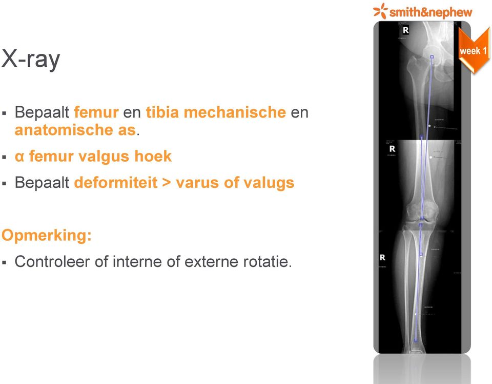 α femur valgus hoek Bepaalt deformiteit >