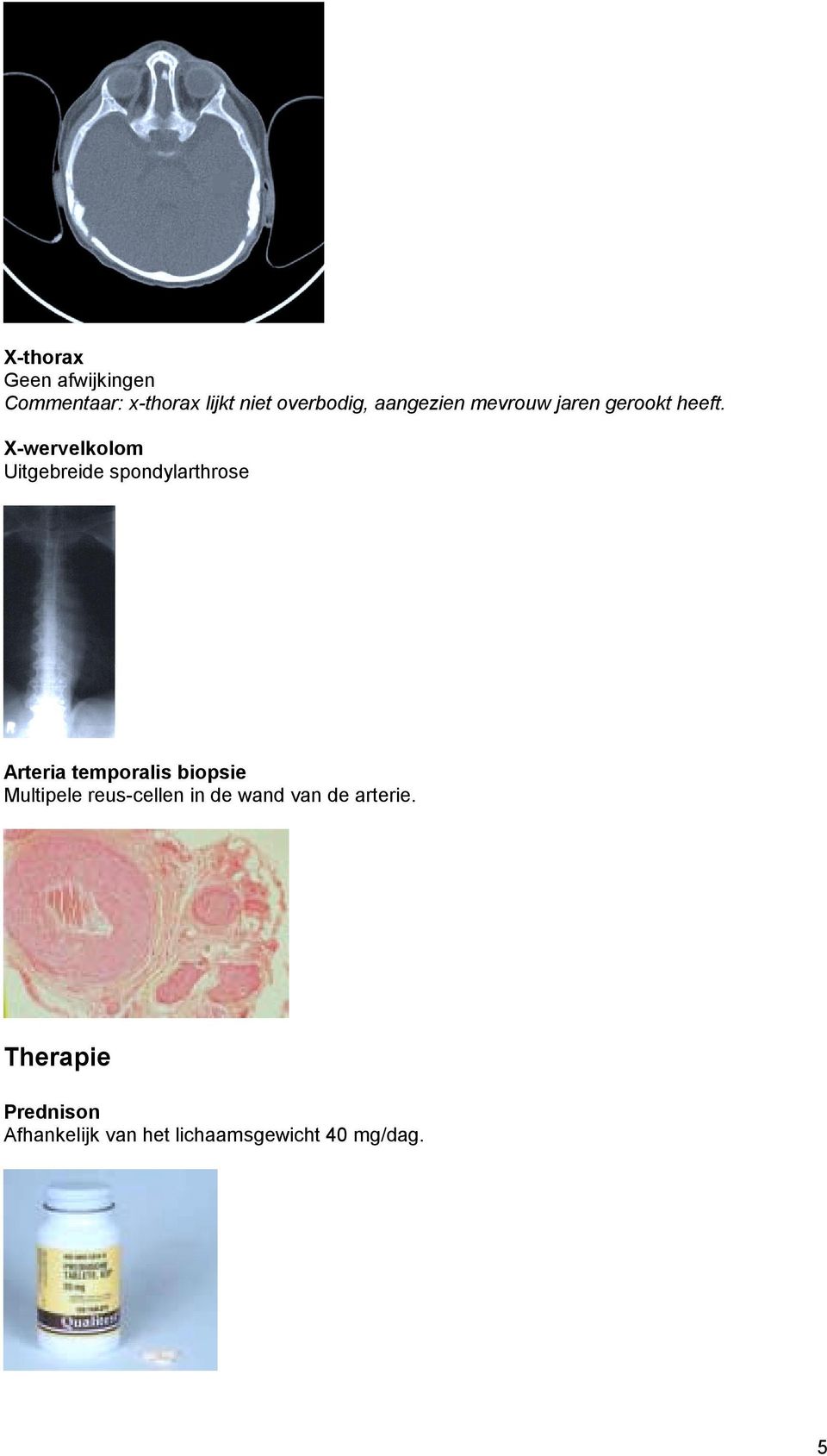 X-wervelkolom Uitgebreide spondylarthrose Arteria temporalis biopsie