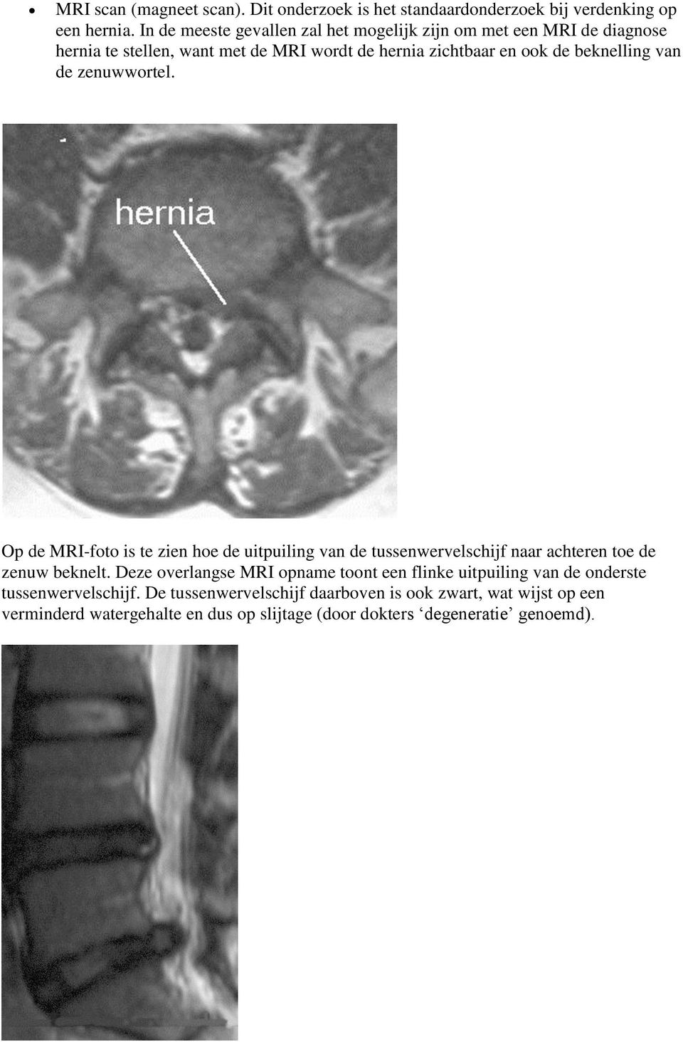 beknelling van de zenuwwortel. Op de MRI-foto is te zien hoe de uitpuiling van de tussenwervelschijf naar achteren toe de zenuw beknelt.