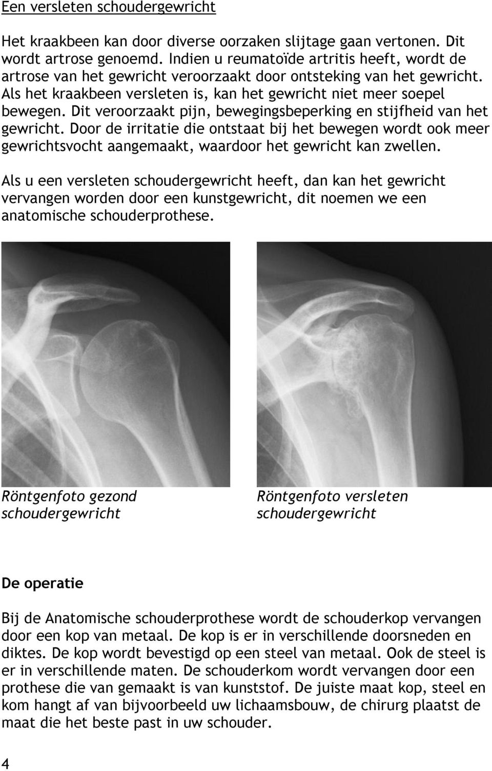 Dit veroorzaakt pijn, bewegingsbeperking en stijfheid van het gewricht. Door de irritatie die ontstaat bij het bewegen wordt ook meer gewrichtsvocht aangemaakt, waardoor het gewricht kan zwellen.