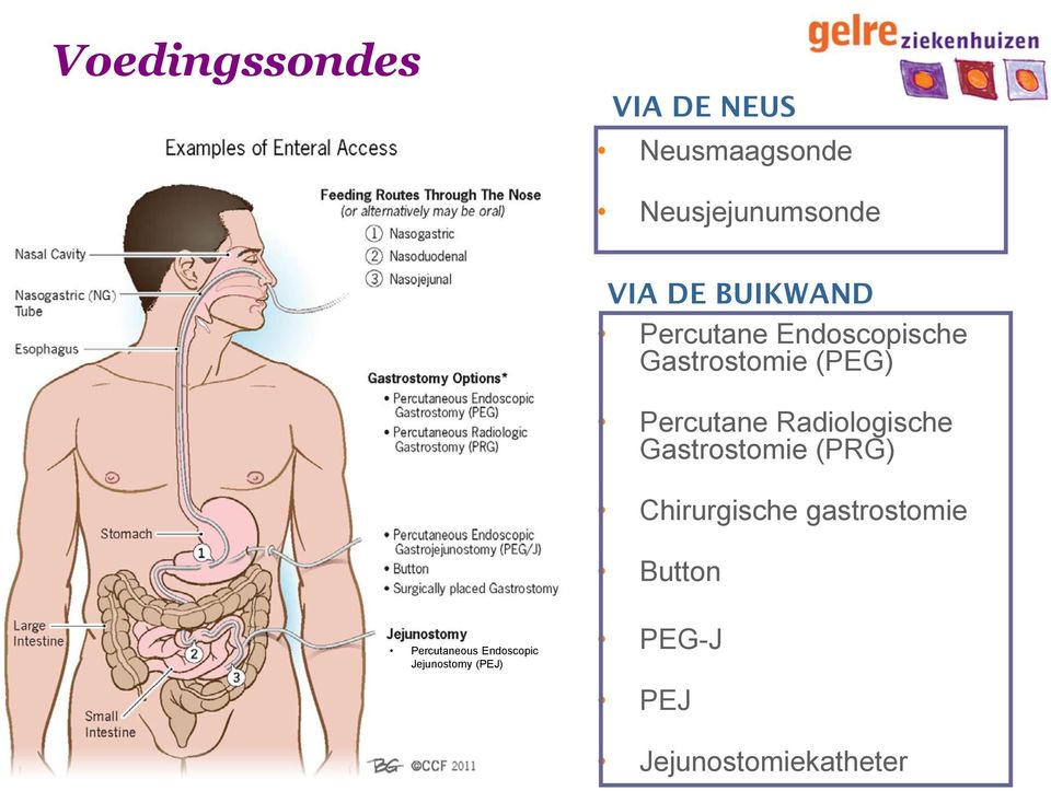 Radiologische Gastrostomie (PRG) Chirurgische gastrostomie Button