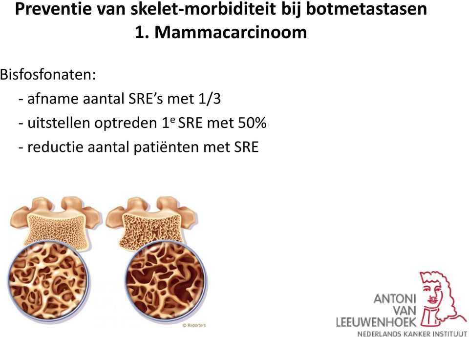 Mammacarcinoom Bisfosfonaten: - afname aantal