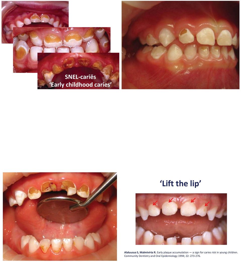 Early plaque accumulation a sign for caries risk