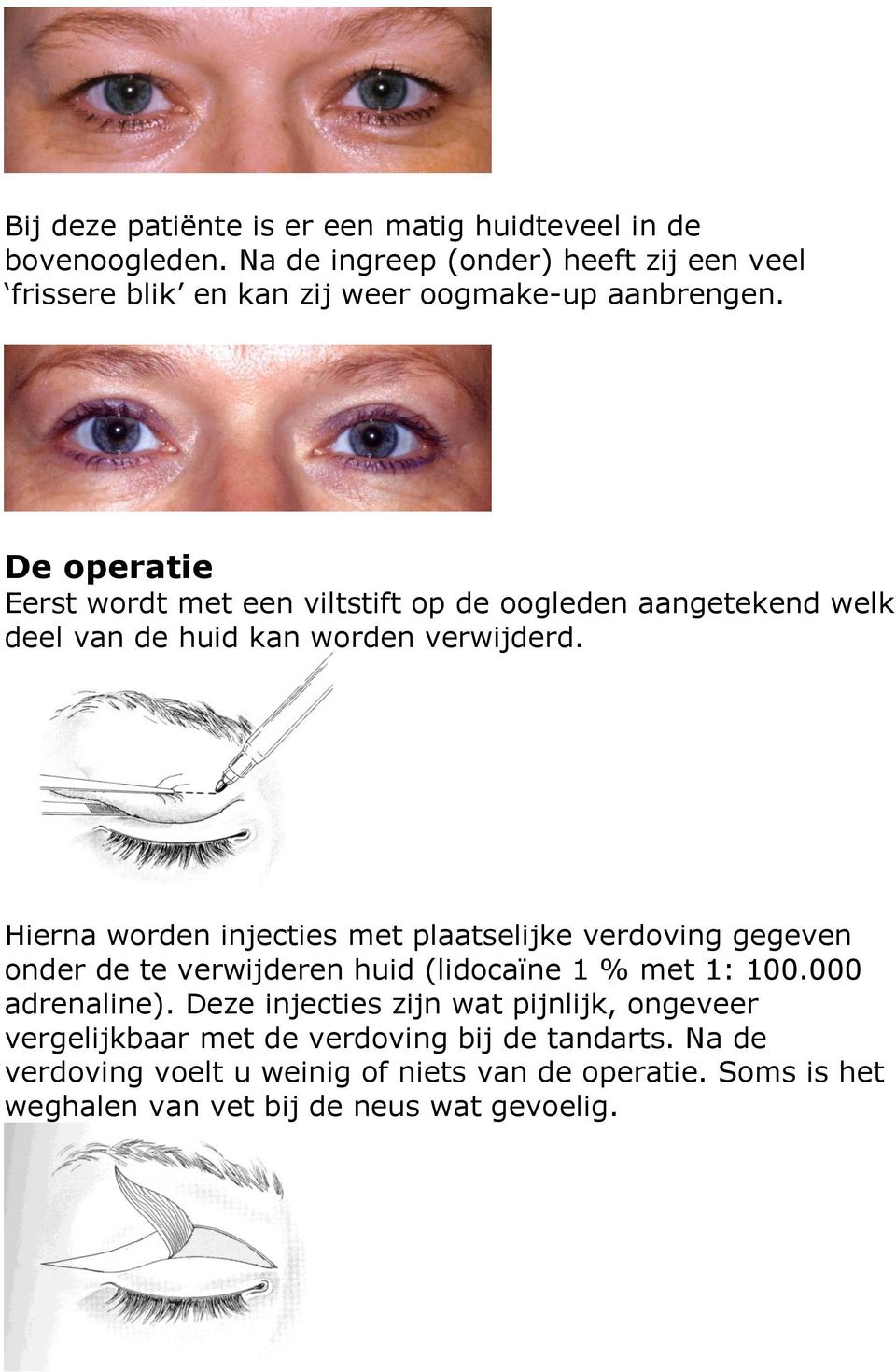 De operatie Eerst wordt met een viltstift op de oogleden aangetekend welk deel van de huid kan worden verwijderd.