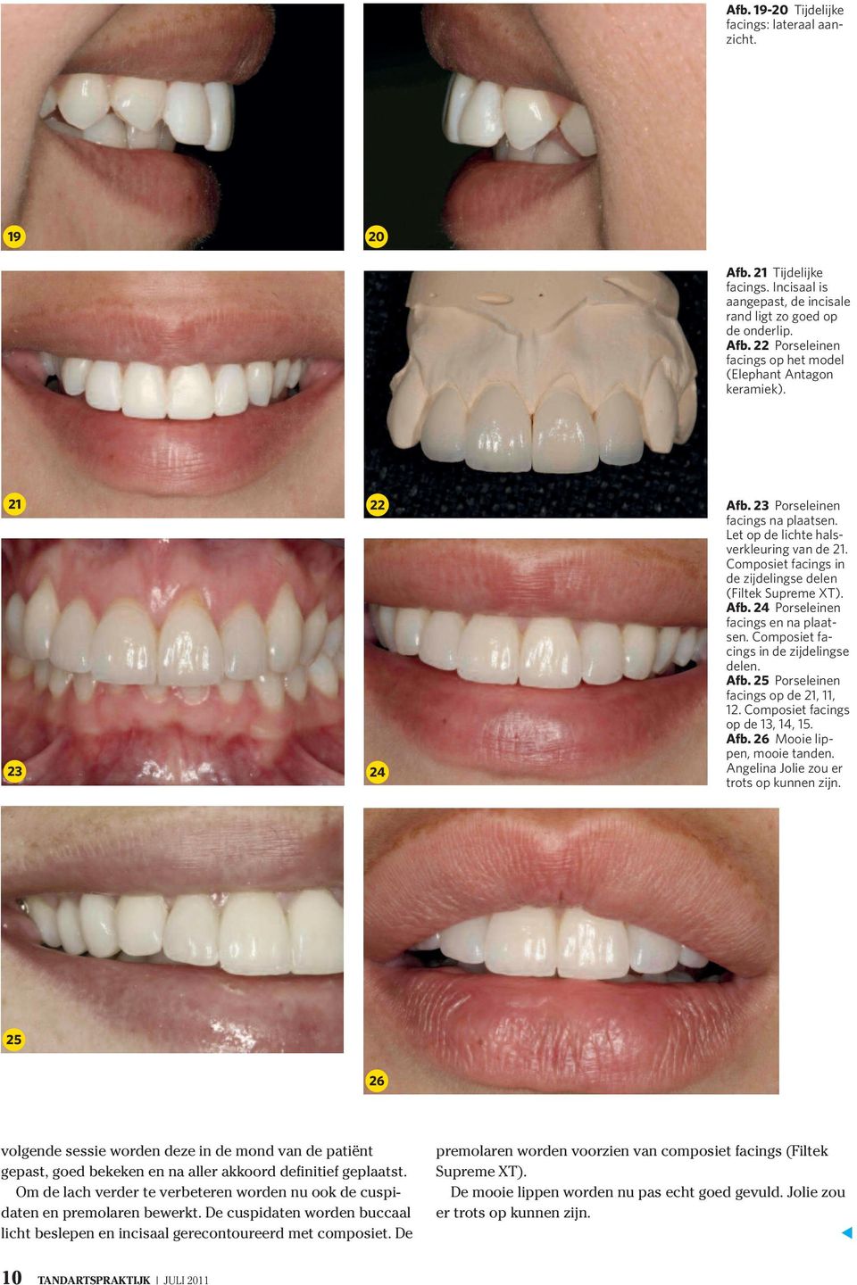 Composiet facings in de zijdelingse delen. Afb. 25 Porseleinen facings op de 21, 11, 12. Composiet facings op de 13, 14, 15. Afb. 26 Mooie lippen, mooie tanden.
