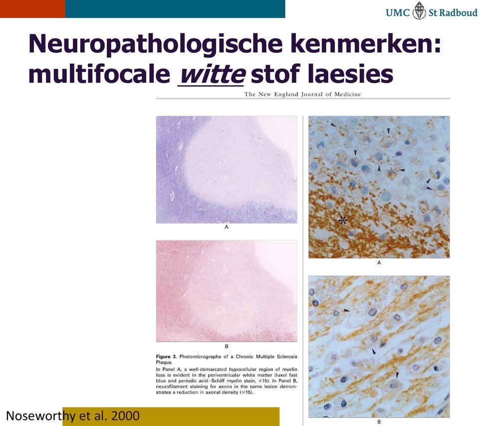 multifocale witte