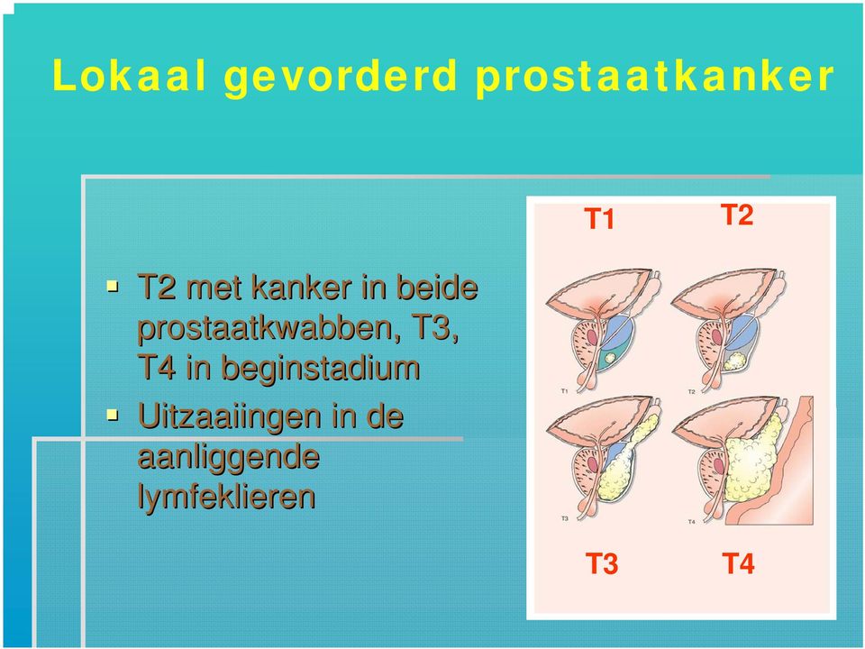prostaatkwabben, T3, T4 in