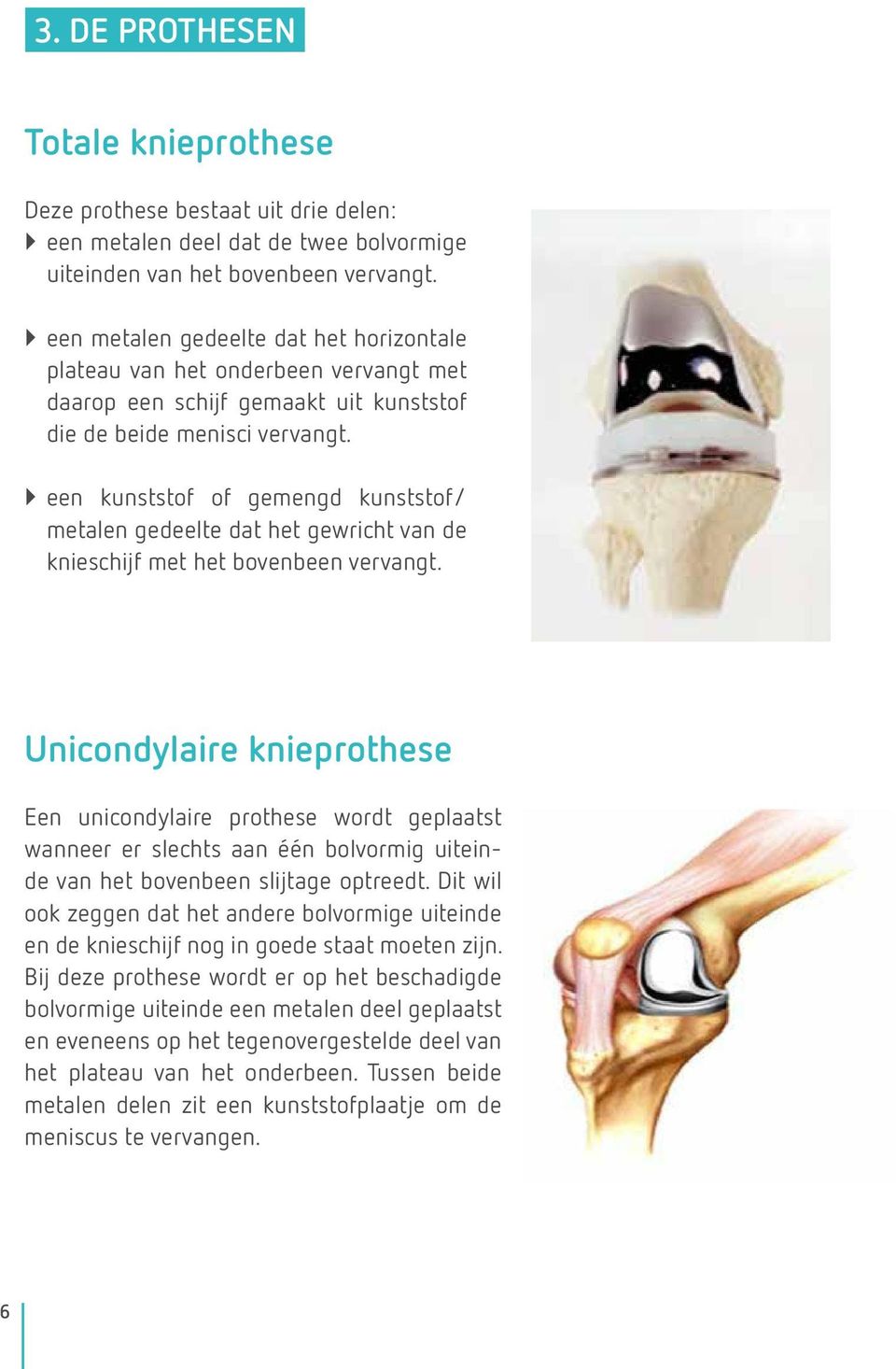 ``een kunststof of gemengd kunststof/ metalen gedeelte dat het gewricht van de knieschijf met het bovenbeen vervangt.