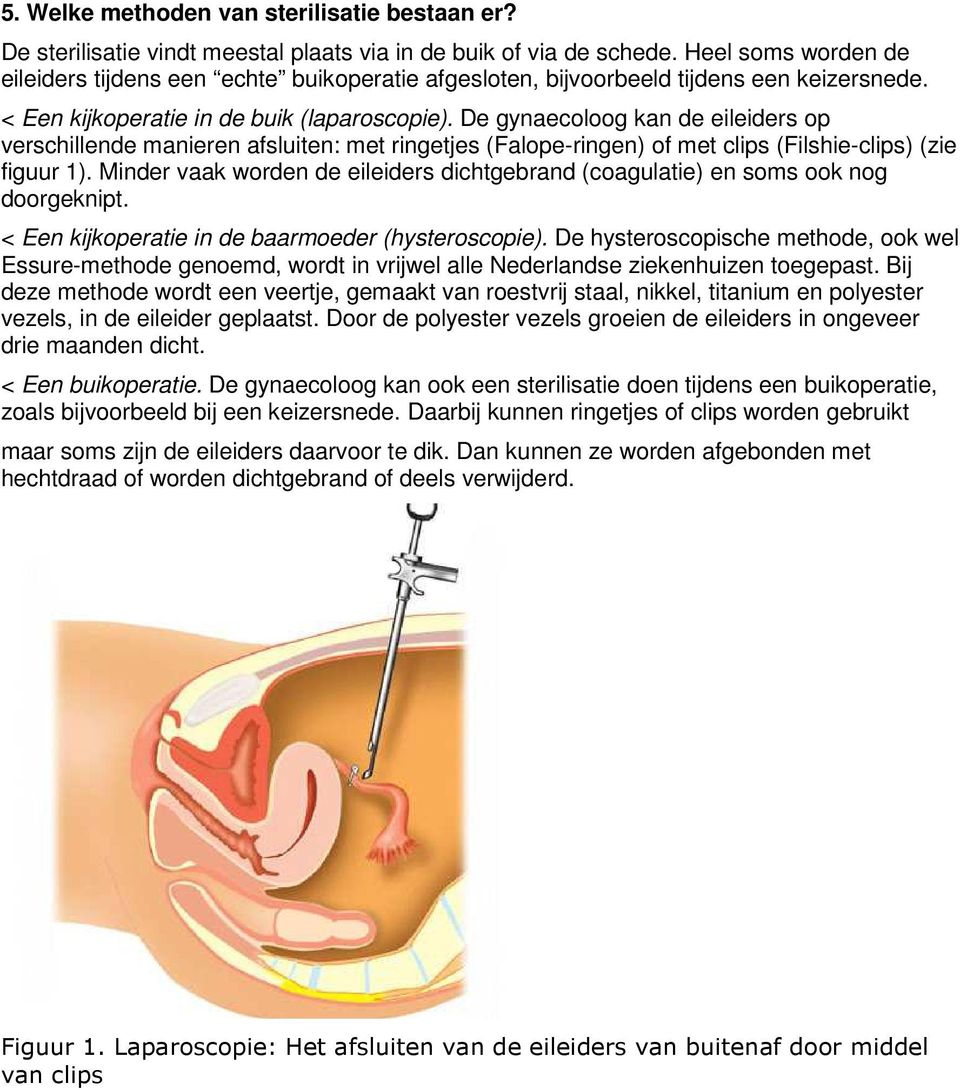 De gynaecoloog kan de eileiders op verschillende manieren afsluiten: met ringetjes (Falope-ringen) of met clips (Filshie-clips) (zie figuur 1).