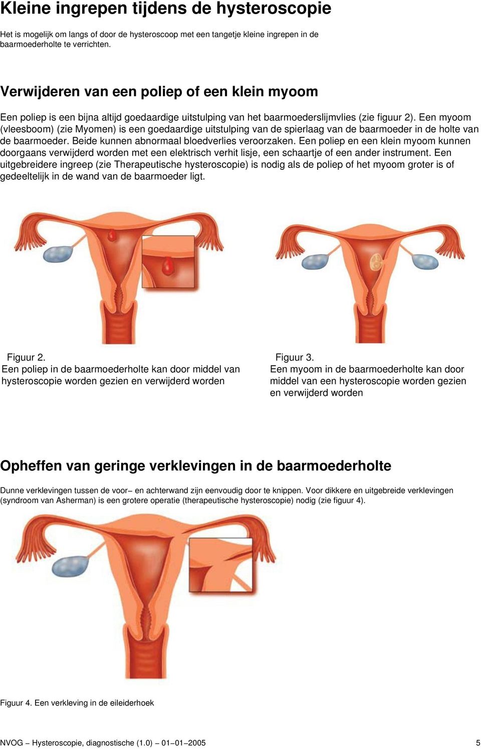 Een myoom (vleesboom) (zie Myomen) is een goedaardige uitstulping van de spierlaag van de baarmoeder in de holte van de baarmoeder. Beide kunnen abnormaal bloedverlies veroorzaken.