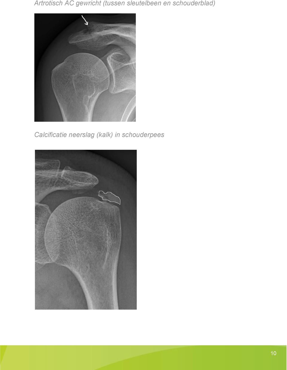 schouderblad) Calcificatie