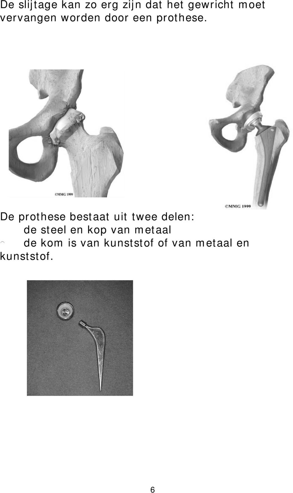 De prthese bestaat uit twee delen: de steel en