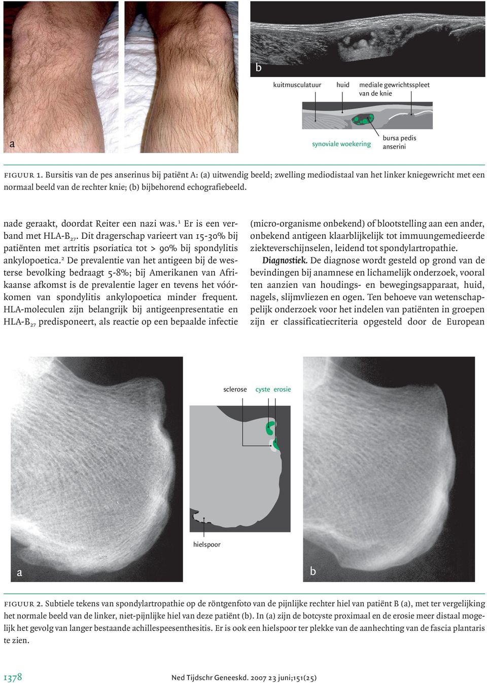 nade geraakt, doordat Reiter een nazi was. 1 Er is een verband met HLA-B 27. Dit dragerschap varieert van 15-30% bij patiënten met artritis psoriatica tot > 90% bij spondylitis ankylopoetica.