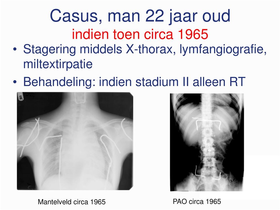 miltextirpatie Behandeling: indien stadium II