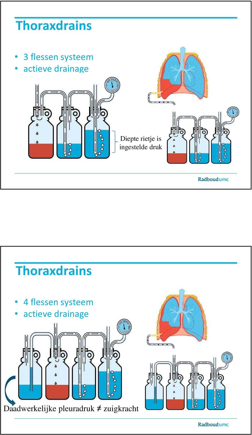 Thoraxdrains 4 flessen systeem actieve