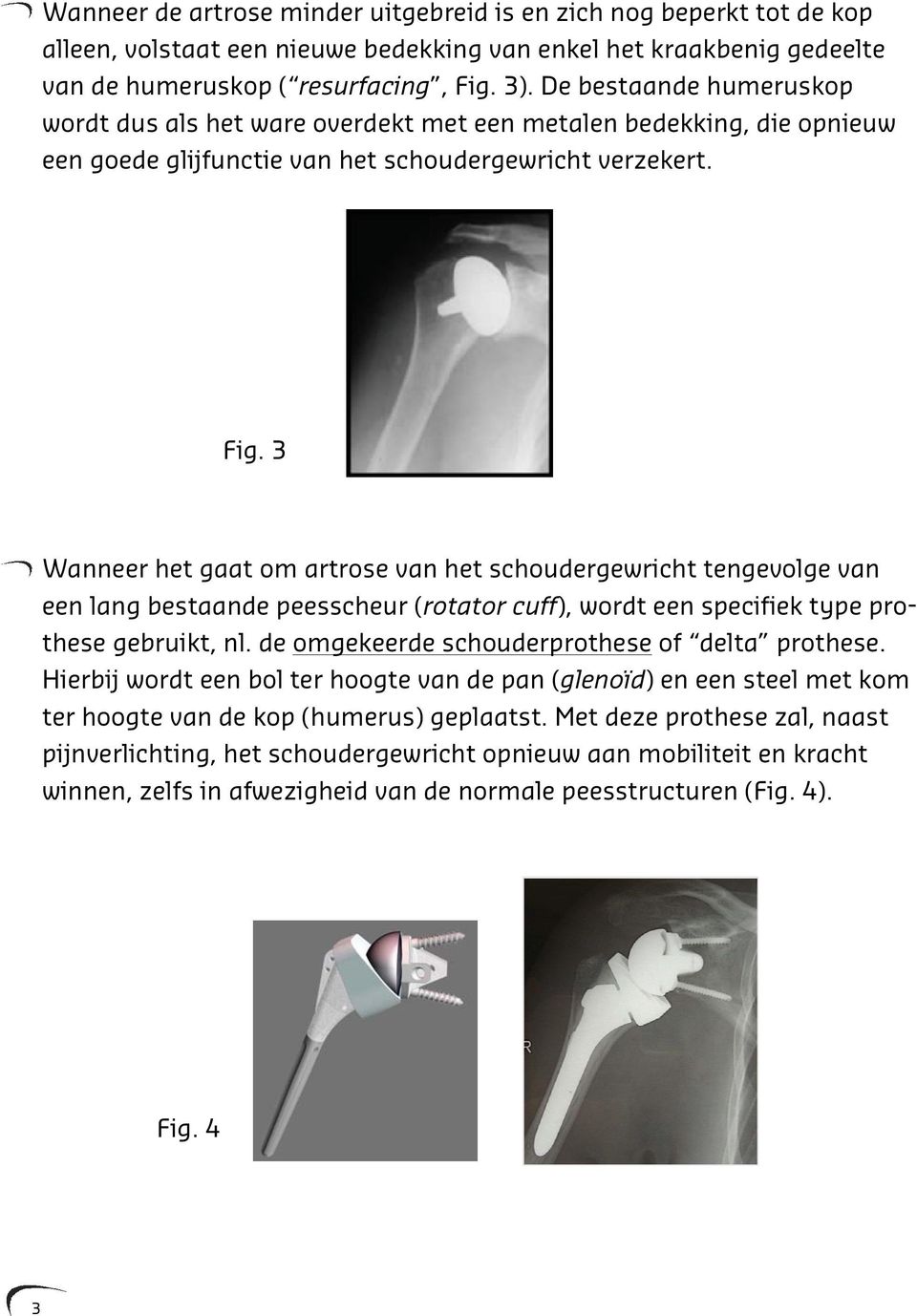 3 Wanneer het gaat om artrose van het schoudergewricht tengevolge van een lang bestaande peesscheur (rotator cuff), wordt een specifiek type prothese gebruikt, nl.
