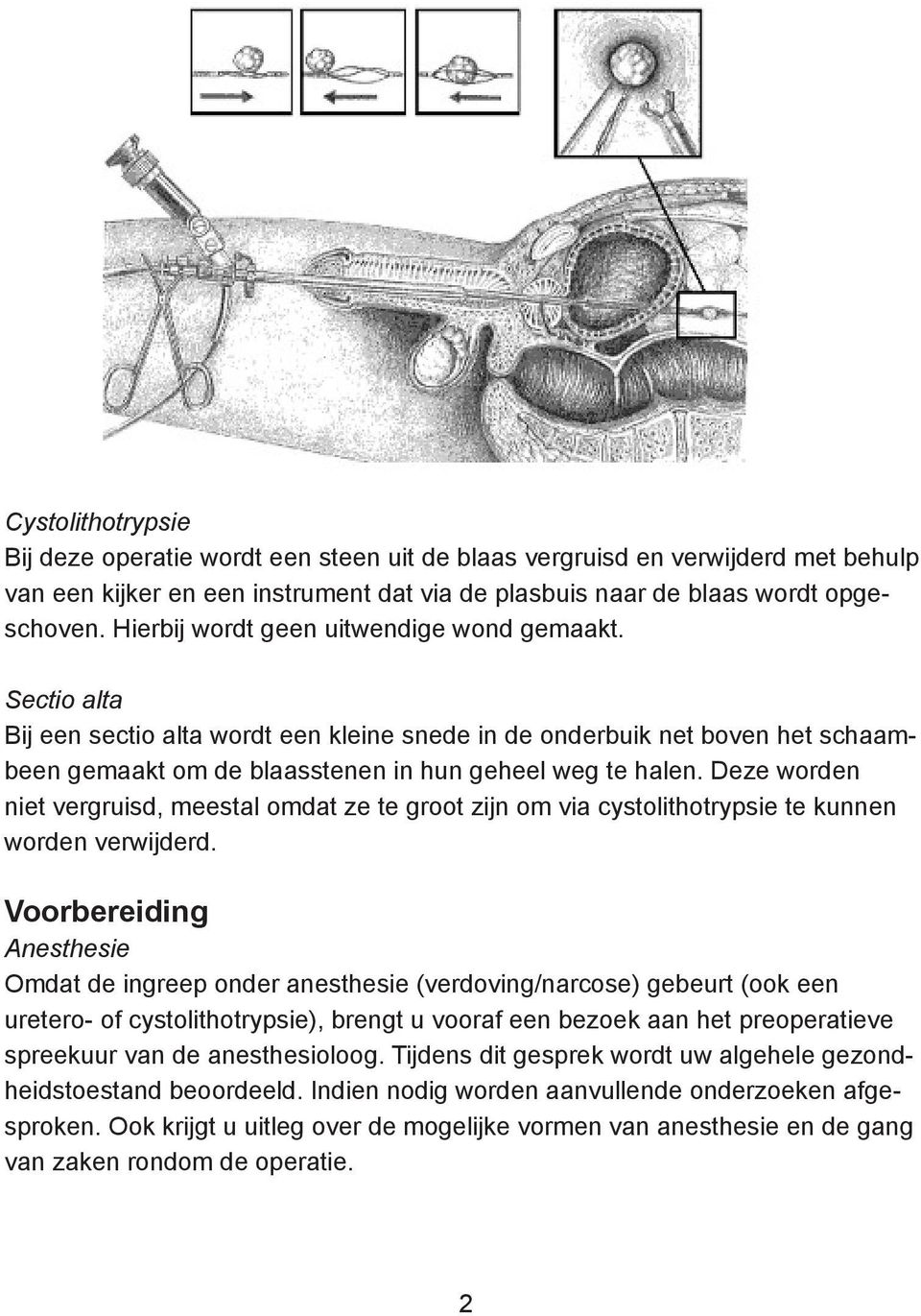 Deze worden niet vergruisd, meestal omdat ze te groot zijn om via cystolithotrypsie te kunnen worden verwijderd.