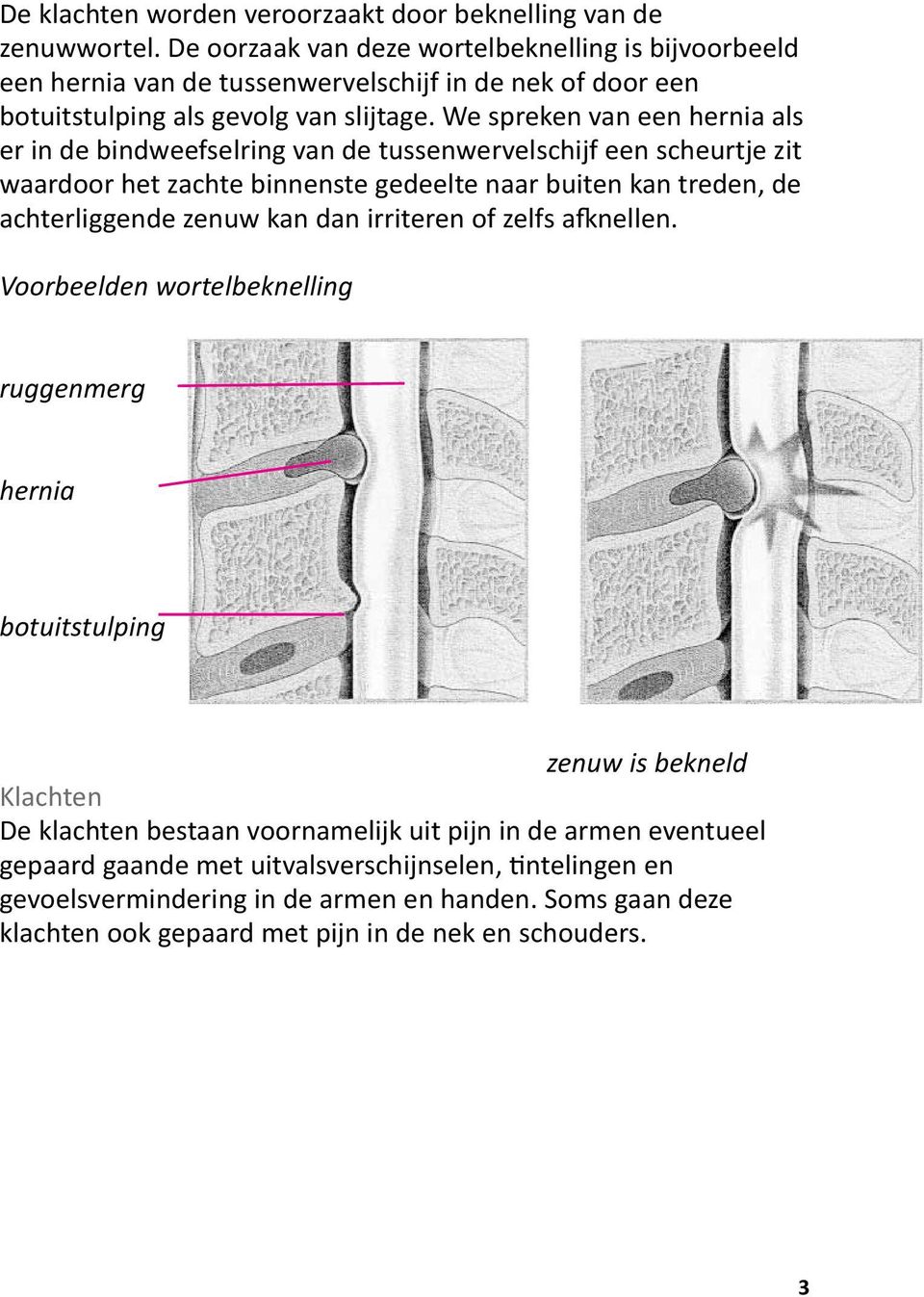 We spreken van een hernia als er in de bindweefselring van de tussenwervelschijf een scheurtje zit waardoor het zachte binnenste gedeelte naar buiten kan treden, de achterliggende zenuw kan