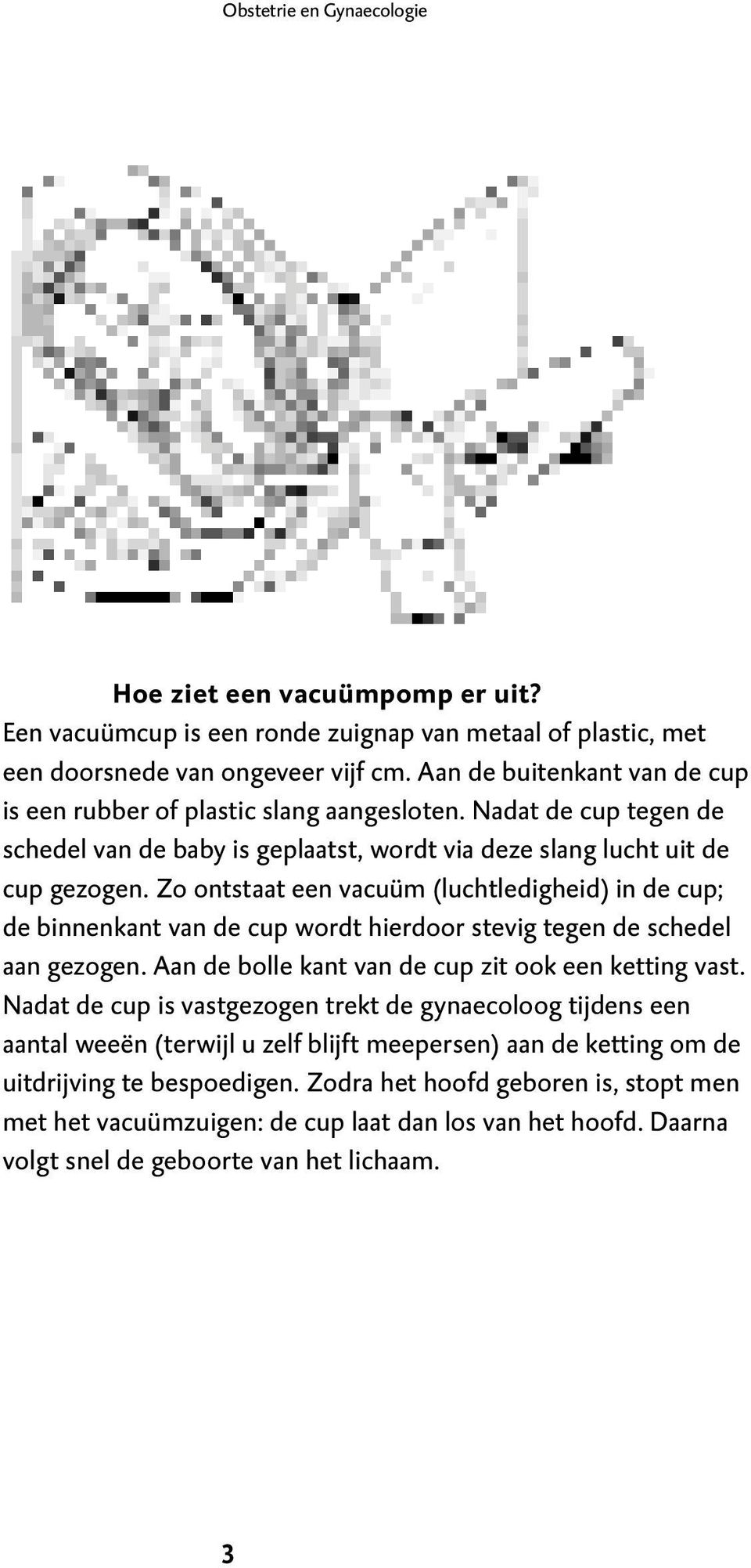 Zo ontstaat een vacuüm (luchtledigheid) in de cup; de binnenkant van de cup wordt hierdoor stevig tegen de schedel aan gezogen. Aan de bolle kant van de cup zit ook een ketting vast.