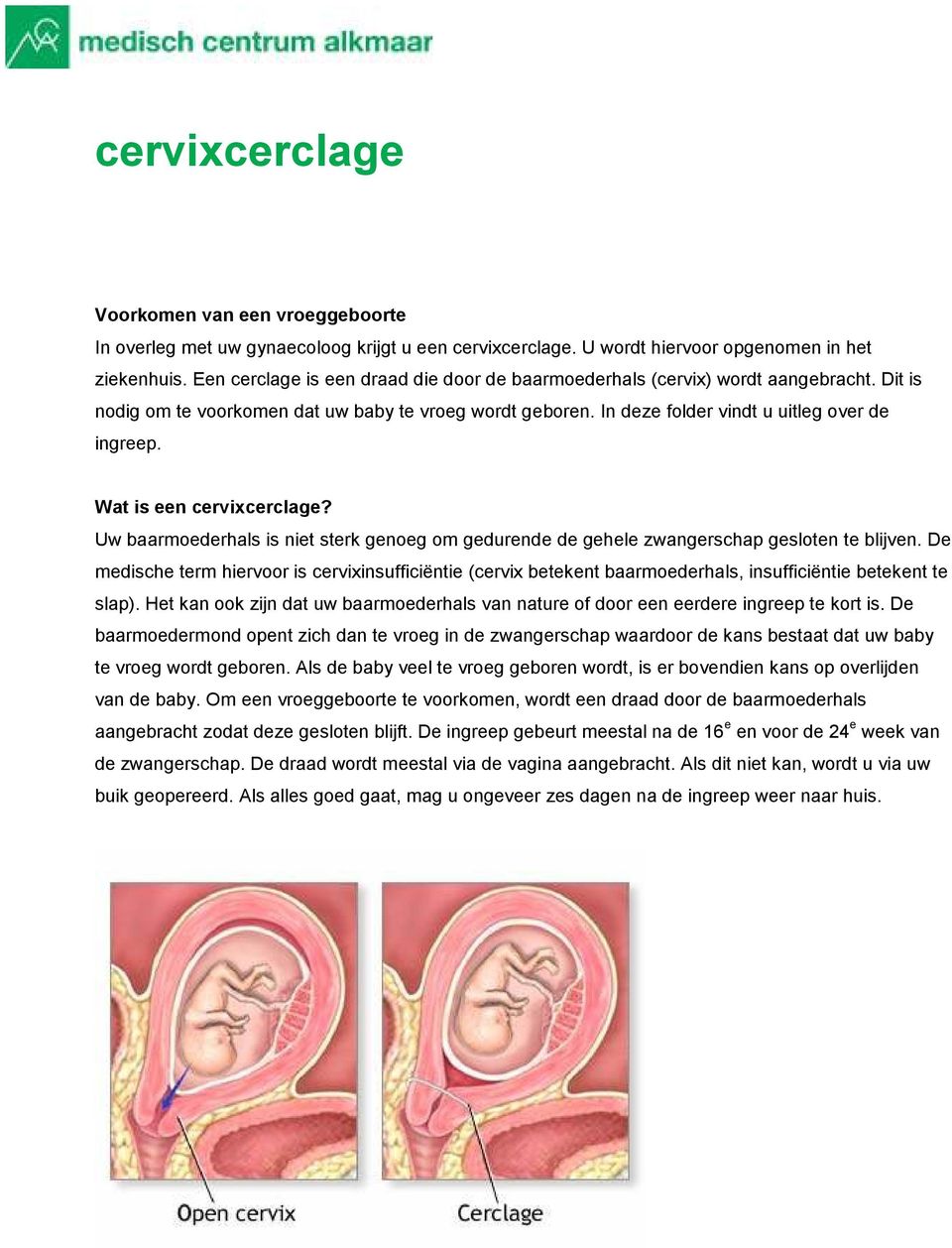 Wat is een cervixcerclage? Uw baarmoederhals is niet sterk genoeg om gedurende de gehele zwangerschap gesloten te blijven.