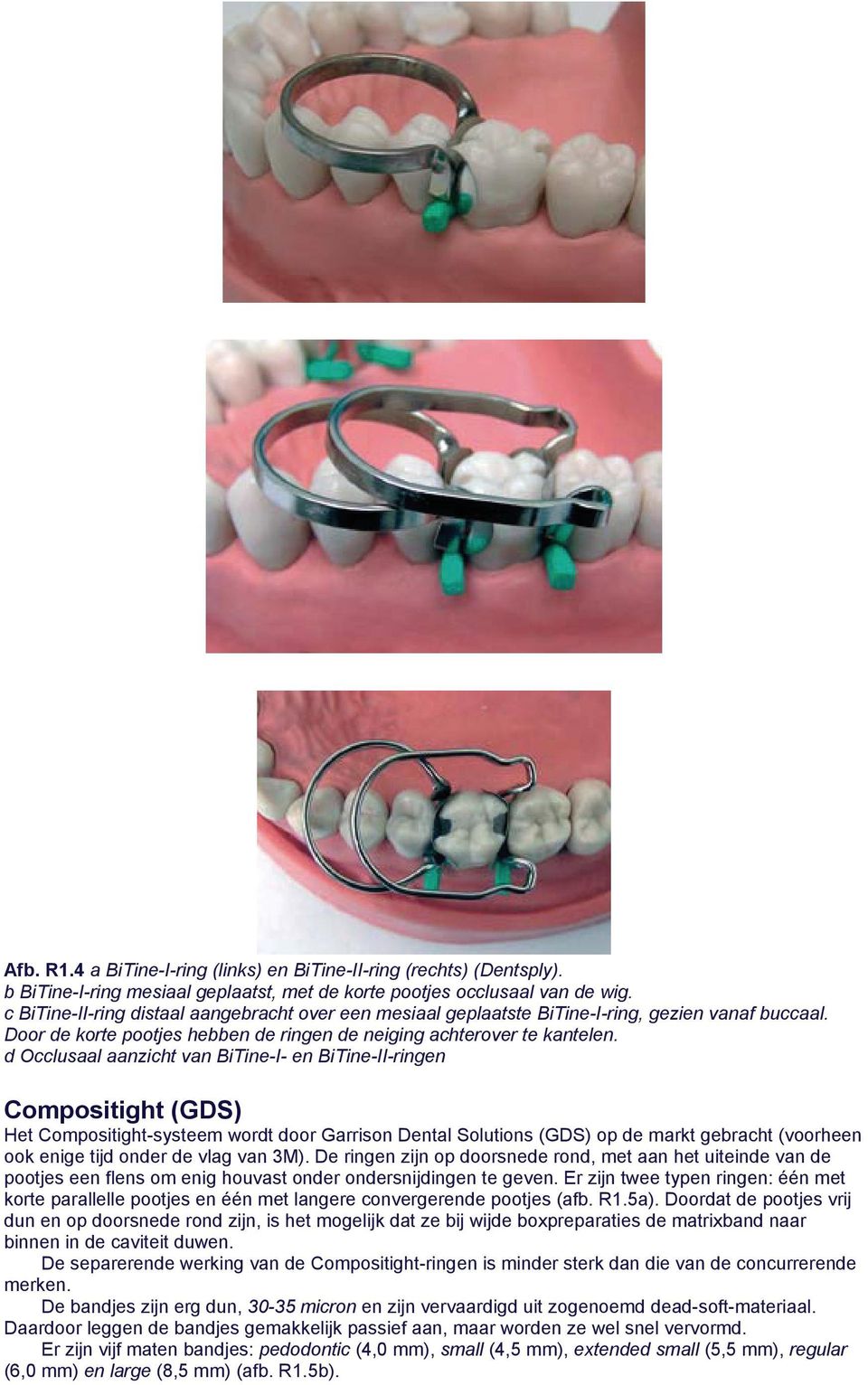 d Occlusaal aanzicht van BiTine-I- en BiTine-II-ringen Compositight (GDS) Het Compositight-systeem wordt door Garrison Dental Solutions (GDS) op de markt gebracht (voorheen ook enige tijd onder de
