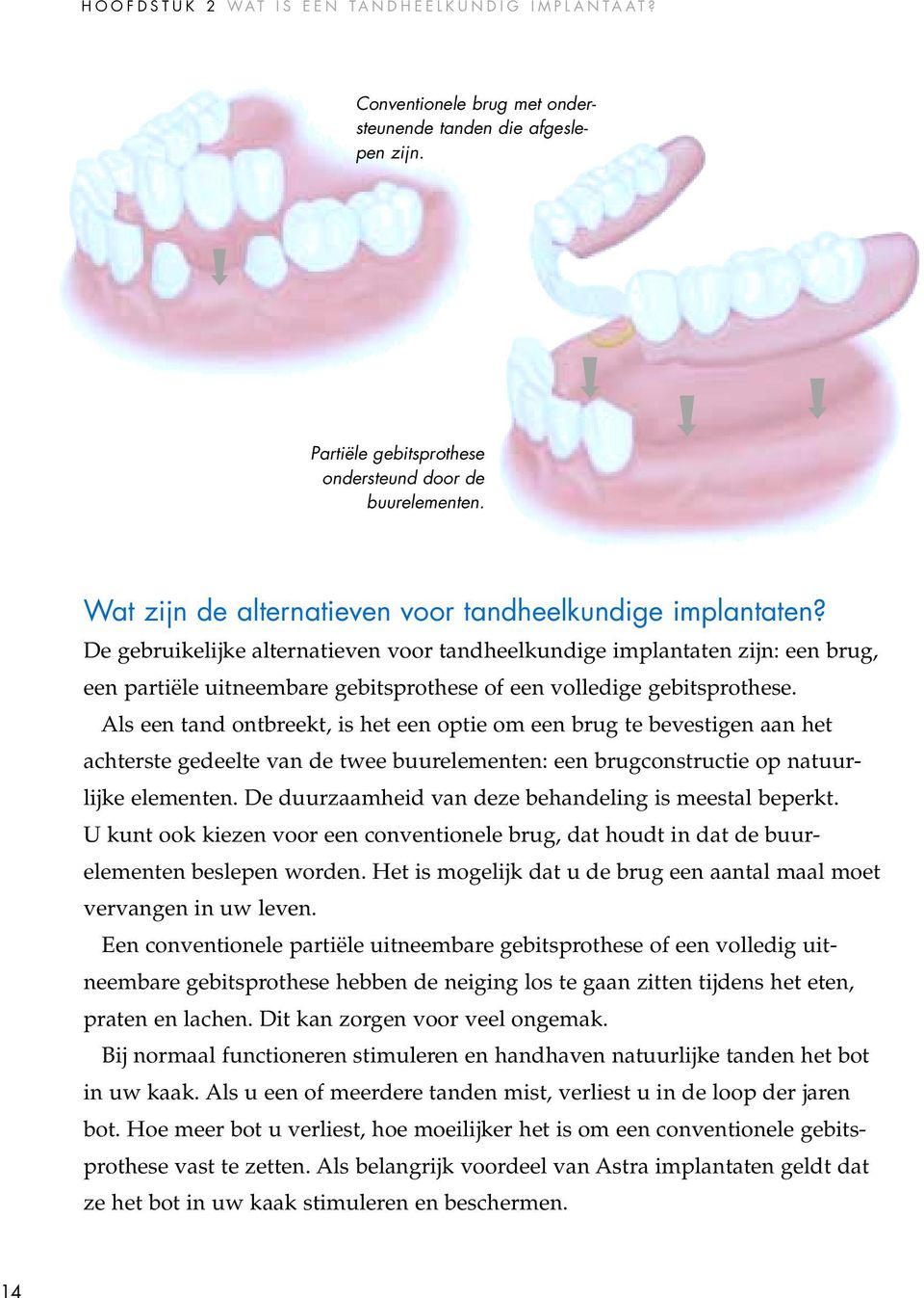 De gebruikelijke alternatieven voor tandheelkundige implantaten zijn: een brug, een partiële uitneembare gebitsprothese of een volledige gebitsprothese.