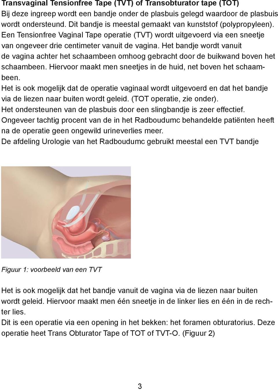 Het bandje wordt vanuit de vagina achter het schaambeen omhoog gebracht door de buikwand boven het schaambeen. Hiervoor maakt men sneetjes in de huid, net boven het schaambeen.