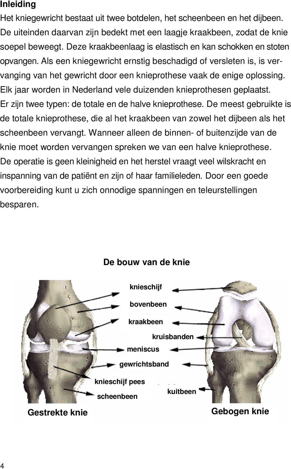 Als een kniegewricht ernstig beschadigd of versleten is, is vervanging van het gewricht door een knieprothese vaak de enige oplossing.