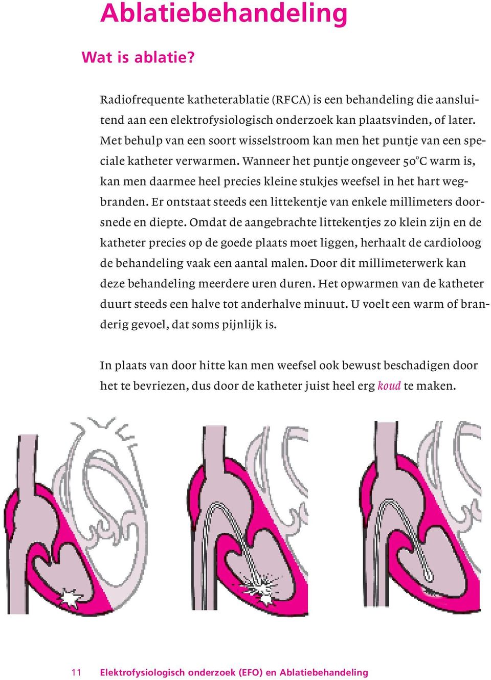 Wanneer het puntje ongeveer 50 0 C warm is, kan men daarmee heel precies kleine stukjes weefsel in het hart wegbranden. Er ontstaat steeds een littekentje van enkele millimeters doorsnede en diepte.