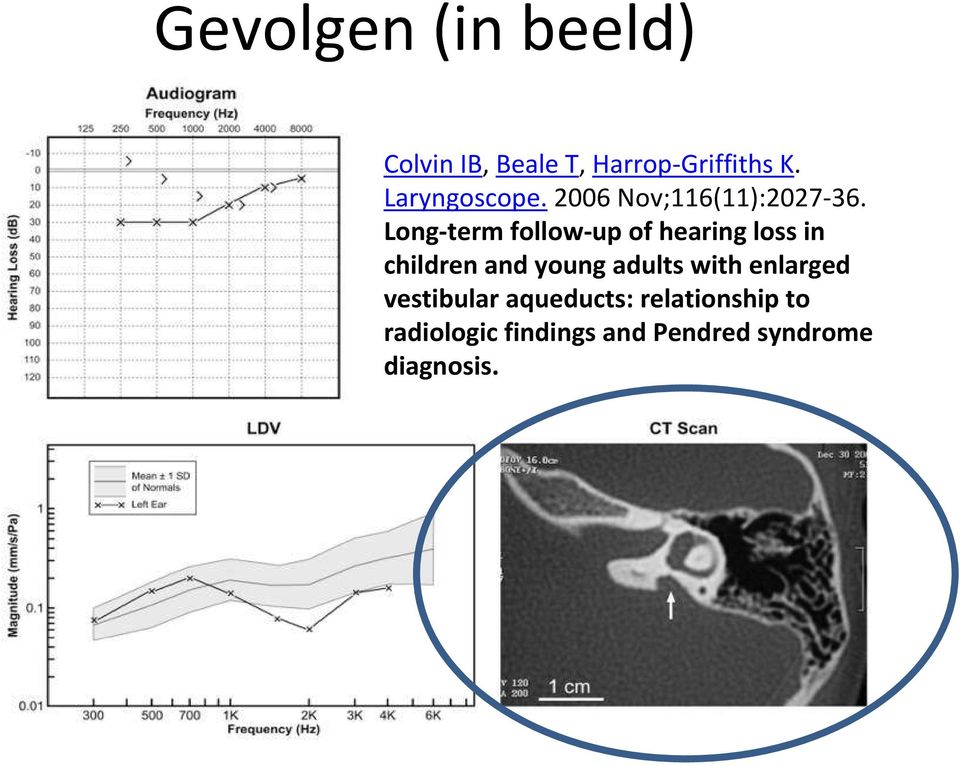 Long term follow up of hearing loss in children and young adults