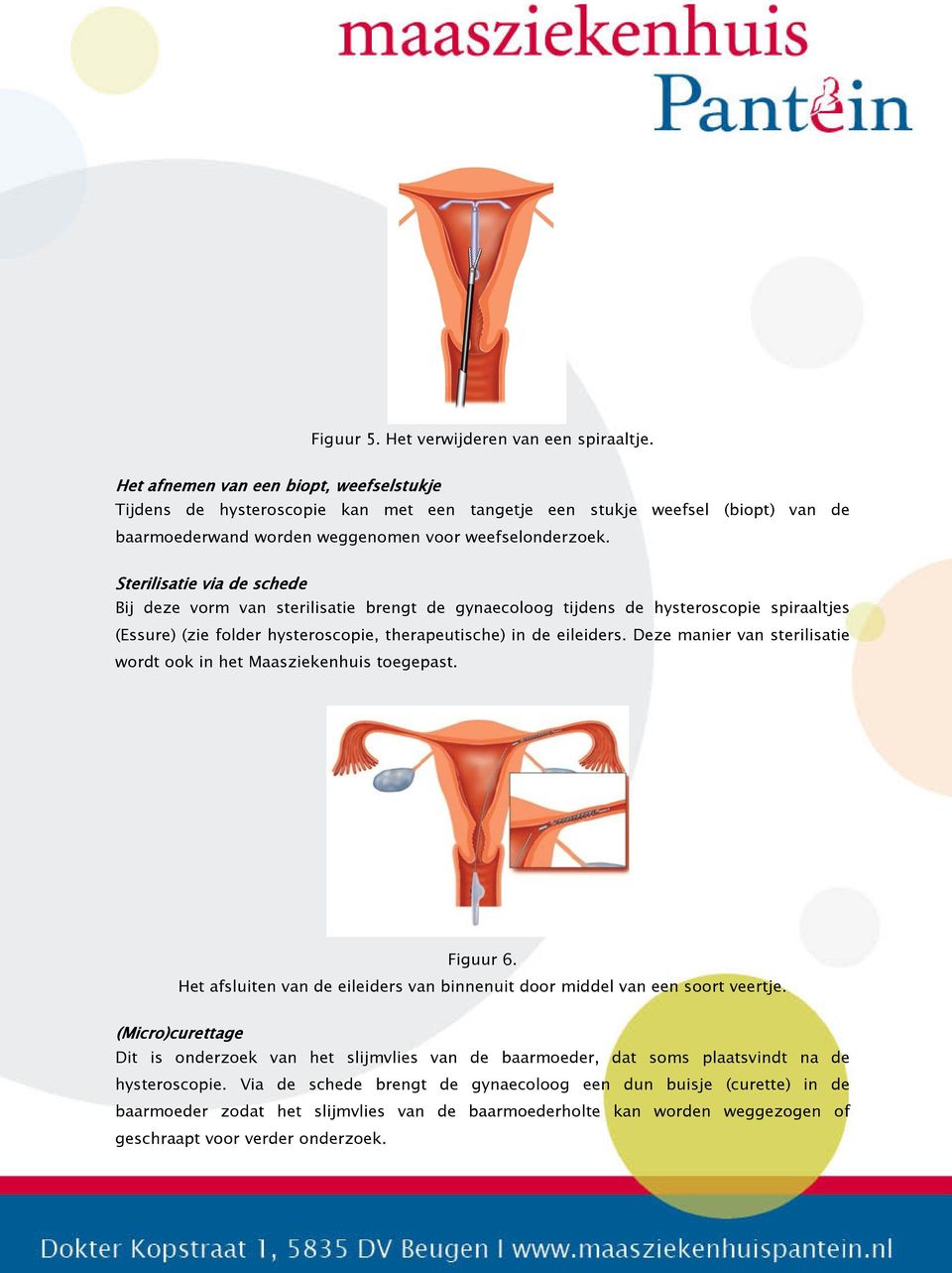 Sterilisatie via de schede Bij deze vorm van sterilisatie brengt de gynaecoloog tijdens de hysteroscopie spiraaltjes (Essure) (zie folder hysteroscopie, therapeutische) in de eileiders.