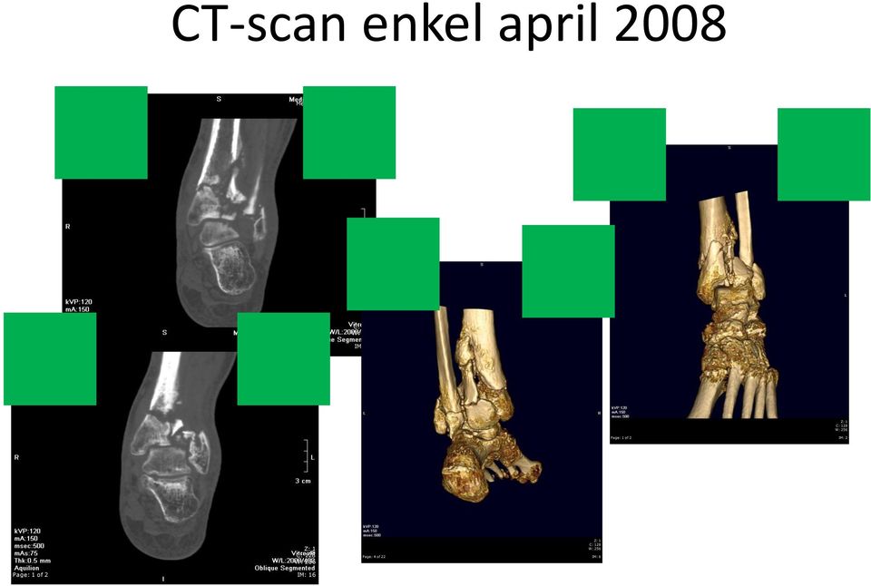 Page: 1 of 2 edisch Spectrum Twente CT Enkel/Voet links VI Snapshot (322) 11-04-2008 14:10:18 343804281 C: 128 W: 256 I: 18 C: 128 W: 256