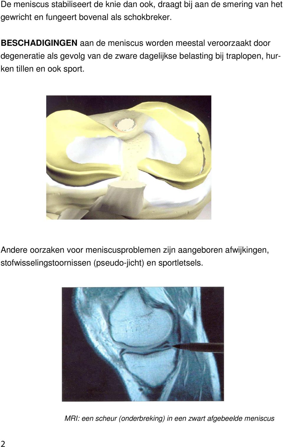 BESCHADIGINGEN aan de meniscus worden meestal veroorzaakt door degeneratie als gevolg van de zware dagelijkse