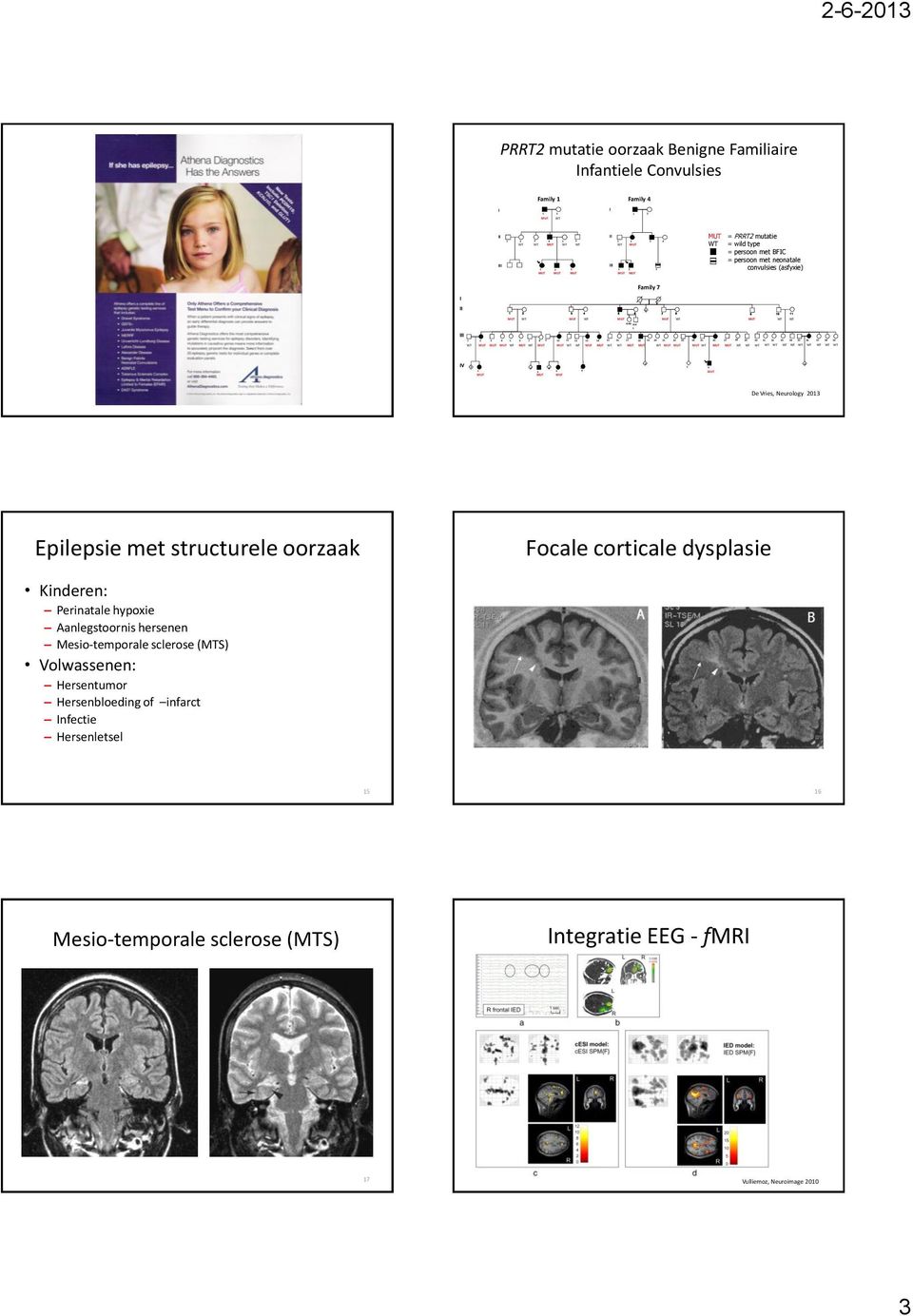 Epilepsie met structurele oorzaak Focale corticale dysplasie Kinderen: Perinatale hypoxie Aanlegstoornis hersenen Mesio-temporale sclerose (MTS)