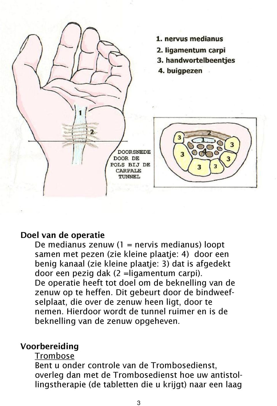 Dit gebeurt door de bindweefselplaat, die over de zenuw heen ligt, door te nemen.