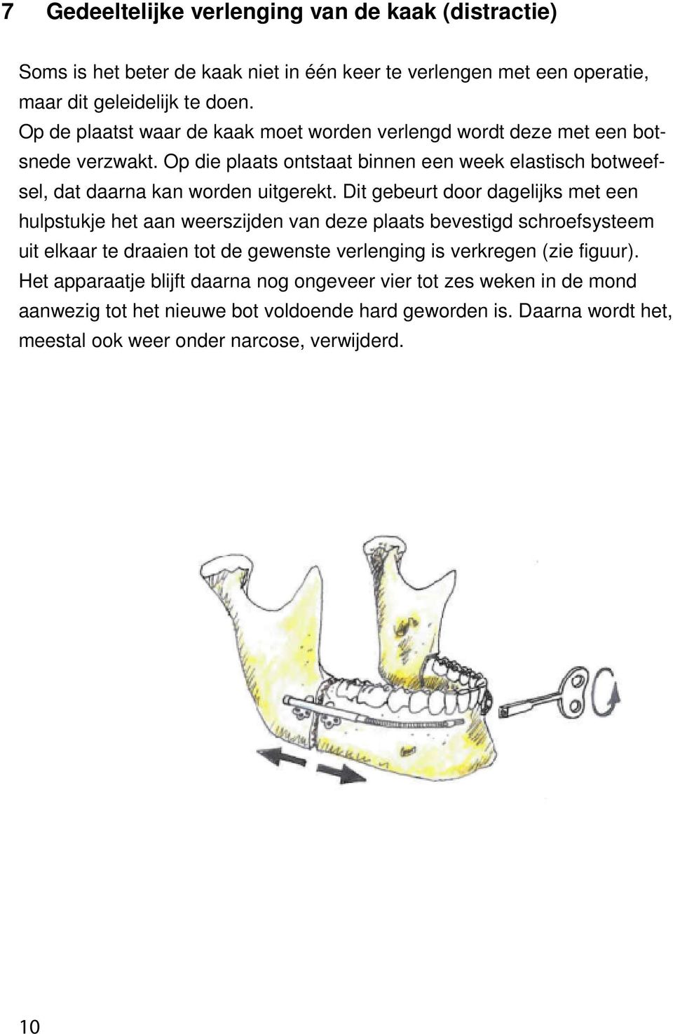 Op die plaats ontstaat binnen een week elastisch botweefsel, dat daarna kan worden uitgerekt.