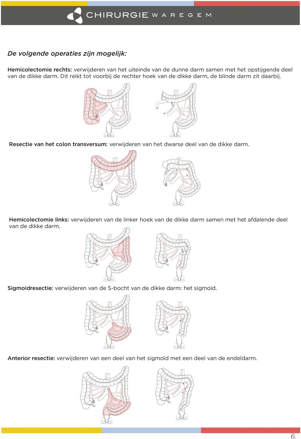Resectie van het colon transversum: verwijderen van het dwarse deel van de dikke darm.