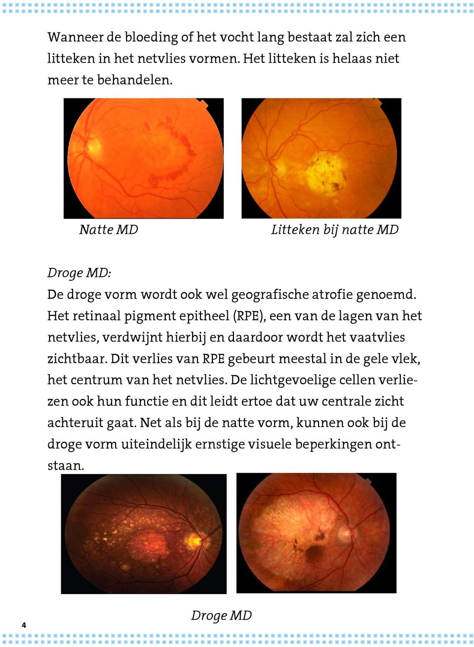 Het retinaal pigment epitheel (RPE), een van de lagen van het netvlies, verdwijnt hierbij en daardoor wordt het vaatvlies zichtbaar.