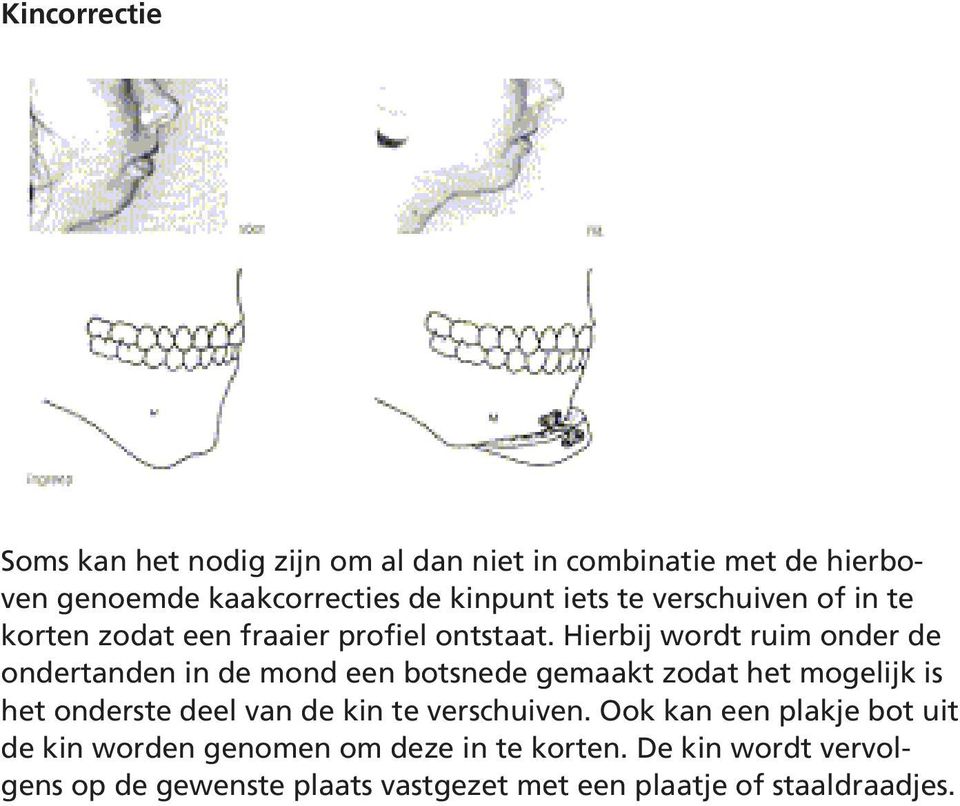 Hierbij wordt ruim onder de ondertanden in de mond een botsnede gemaakt zodat het mogelijk is het onderste deel van de kin