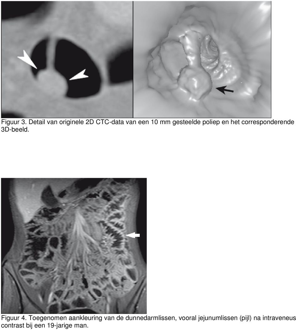 poliep en het corresponderende 3D-beeld. Figuur 4.