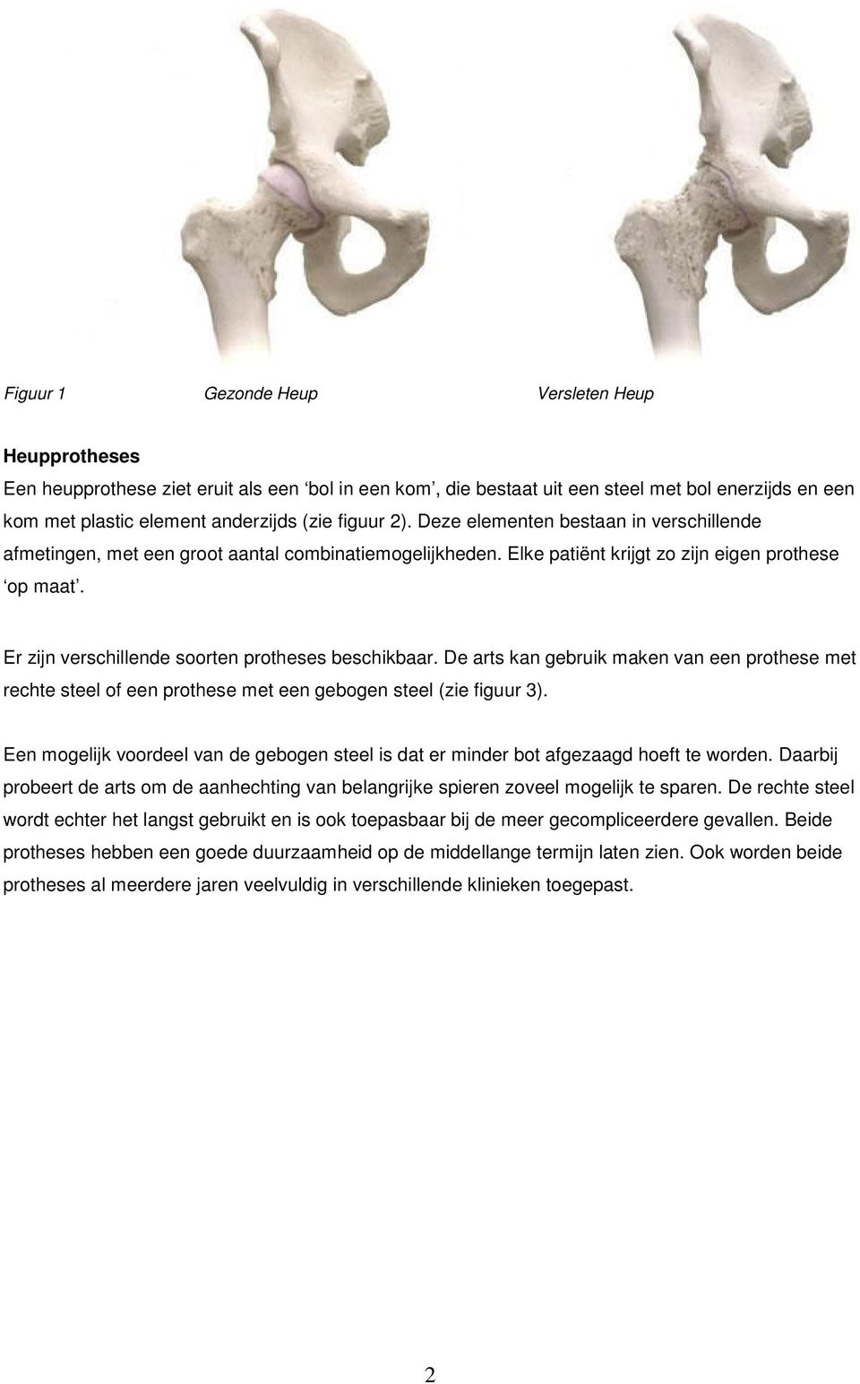 Er zijn verschillende soorten protheses beschikbaar. De arts kan gebruik maken van een prothese met rechte steel of een prothese met een gebogen steel (zie figuur 3).